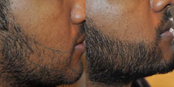 Before and after beard transplant results