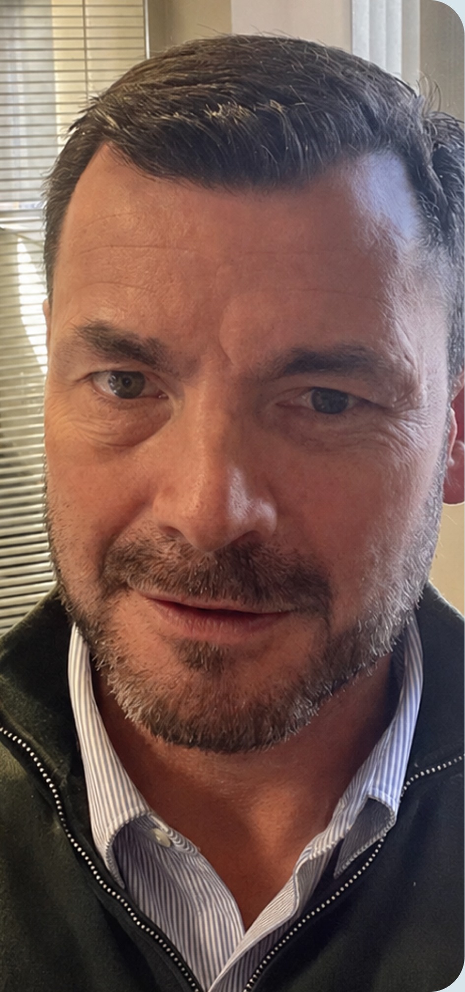 After hair transplant