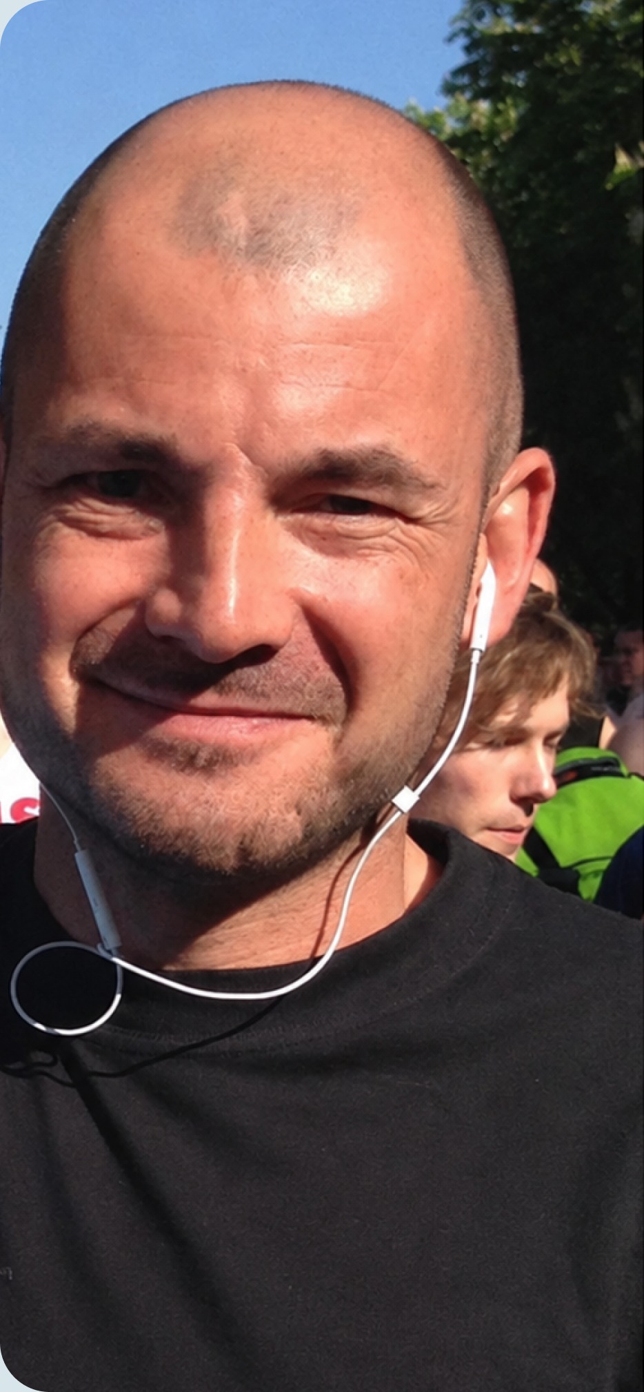 Before hair transplant