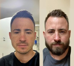 Before and after beard transplant results