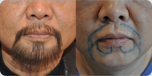 Before and after mustache and guotie transplant results