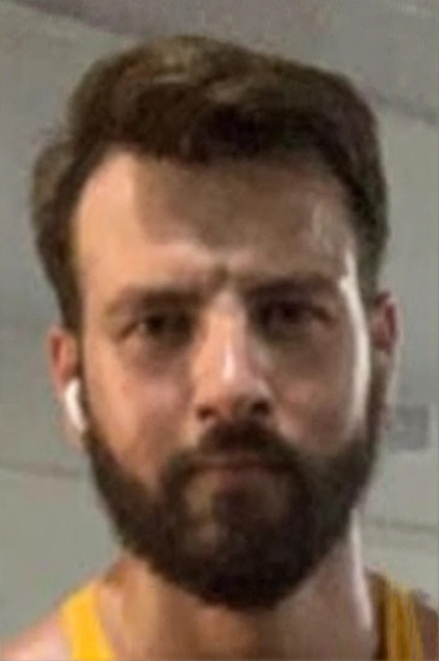 After beard transplant results