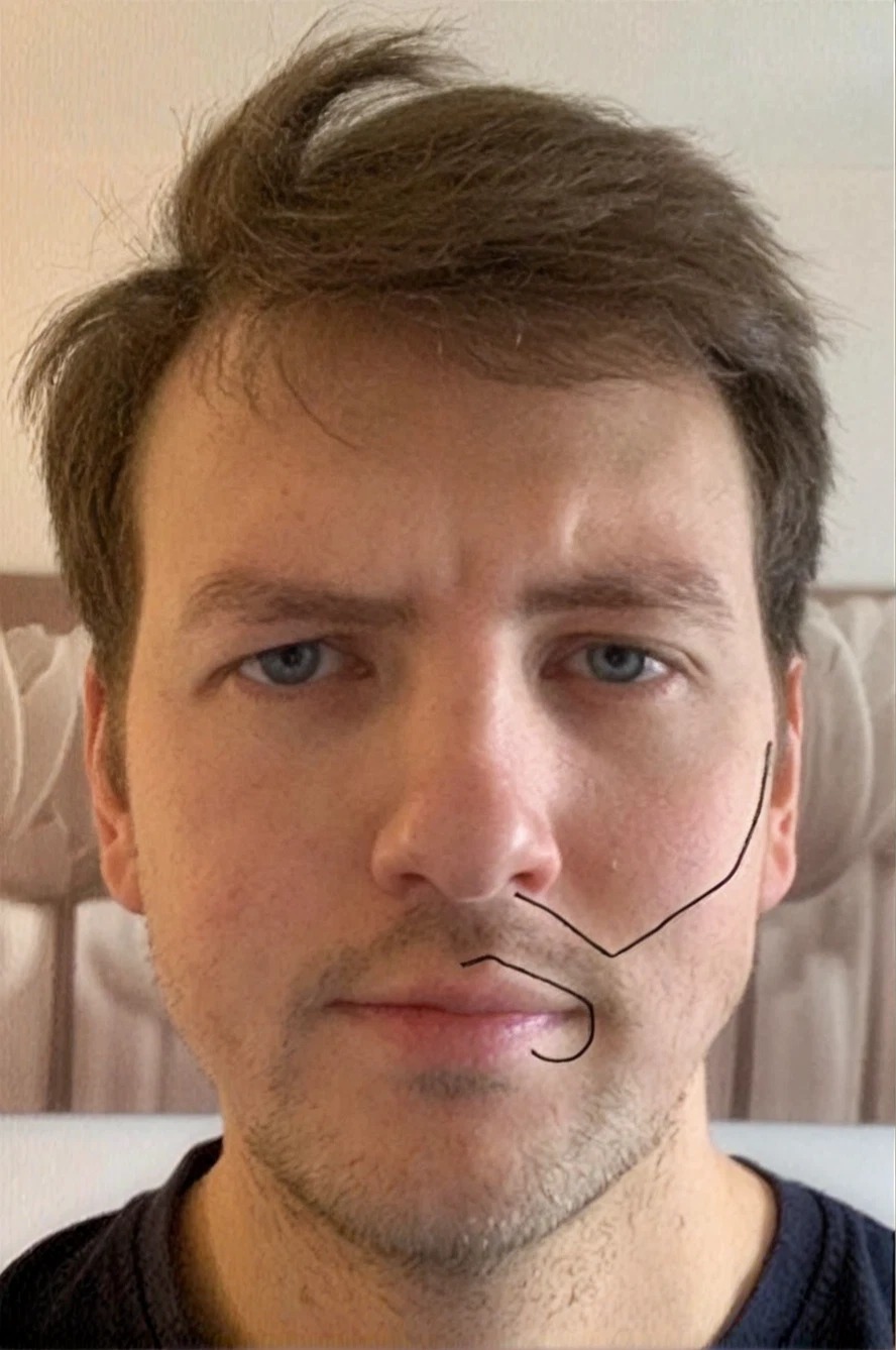 Before beard transplant results