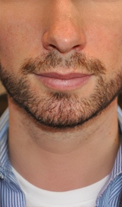 After facial hair transplant results