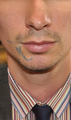 Before facial hair transplant