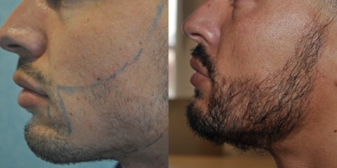 Before and after beard transplant results