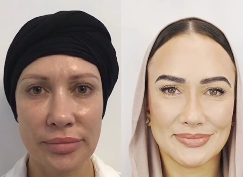 Before and after eyebrow transplant results