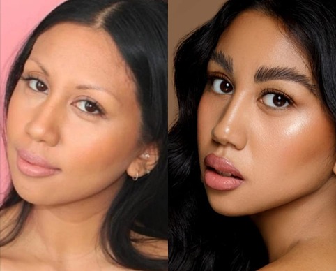 Before and after eyebrow transplant results