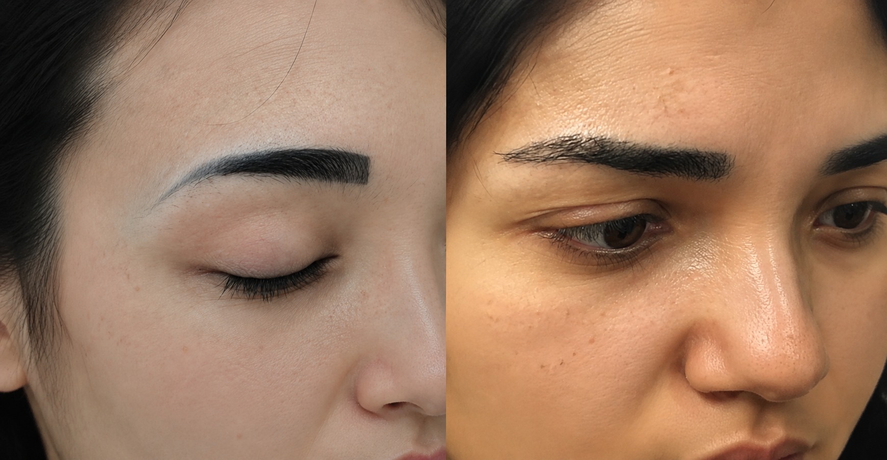 Before and after brow transplant results