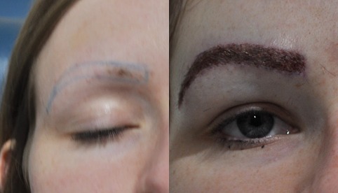 Before and after eyebrow transplant results