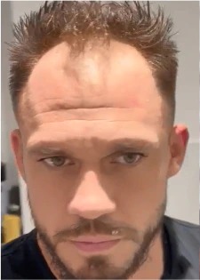 Wimpole hair restoration before