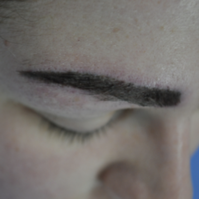 Eyebrow transplant after 1