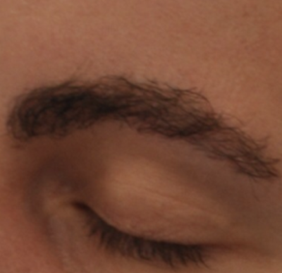 Eyebrow transplant after 3