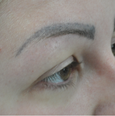 Eyebrow transplant before 1
