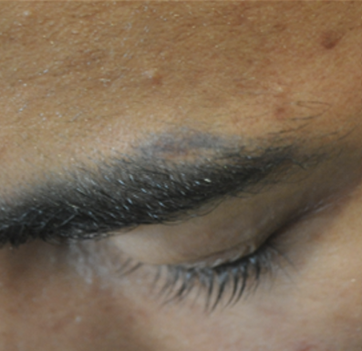 Eyebrow transplant before 2