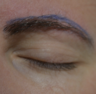 Eyebrow transplant before 3