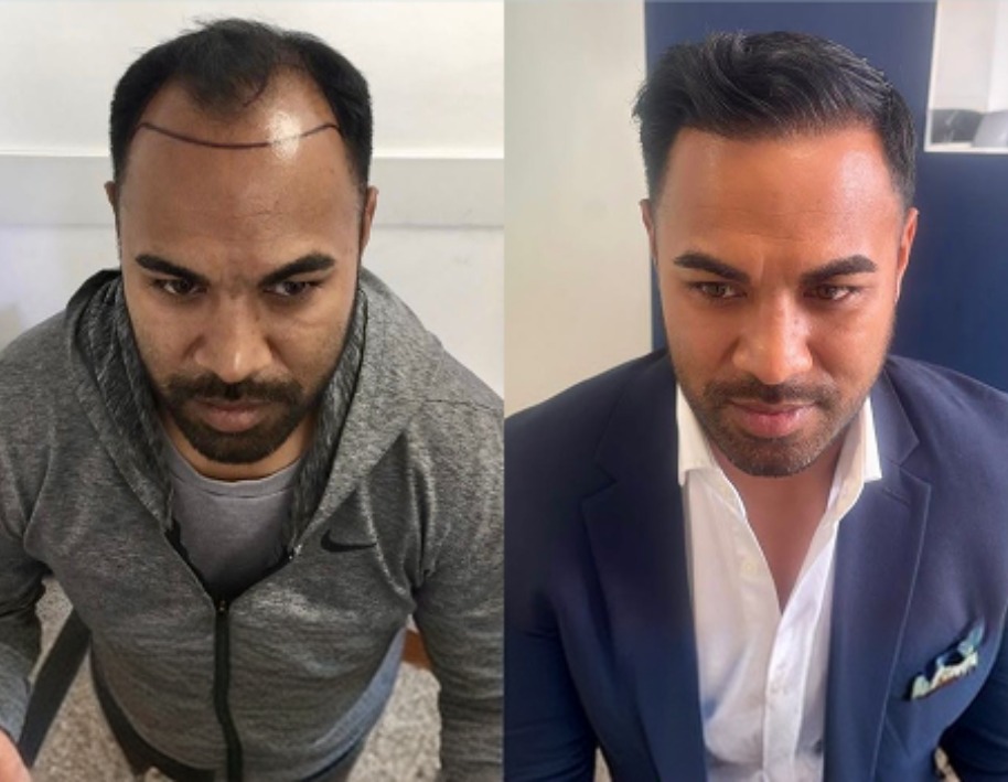 Wimpole hair restoration before and after results
