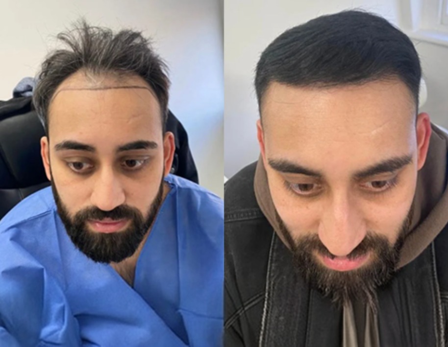 Wimpole hair restoration before and after results