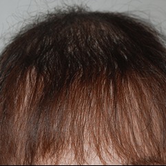 After hair transplant results