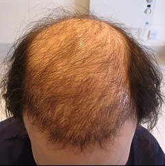 Before hair transplant results