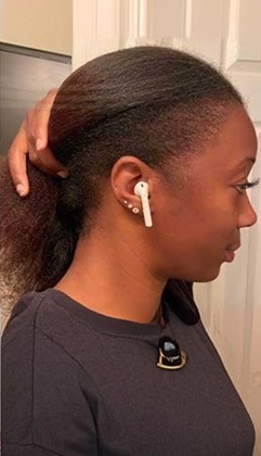After hair transplant results