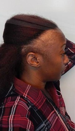 Before hair transplant