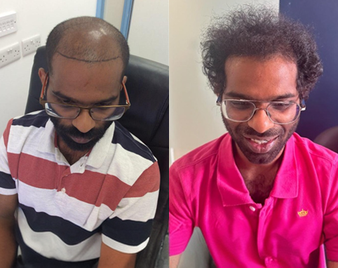 Before and after hair transplant results