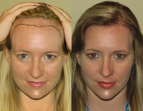 Before and after hair transplant results