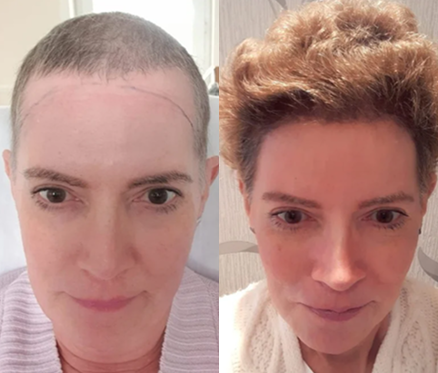 Female before and after hair transplant results
