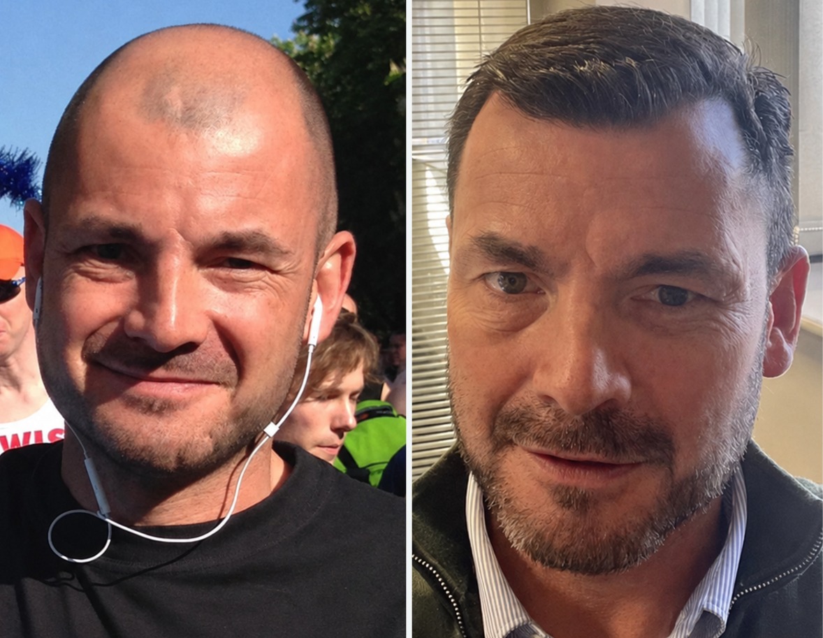 Wimpole hair restoration before and after results