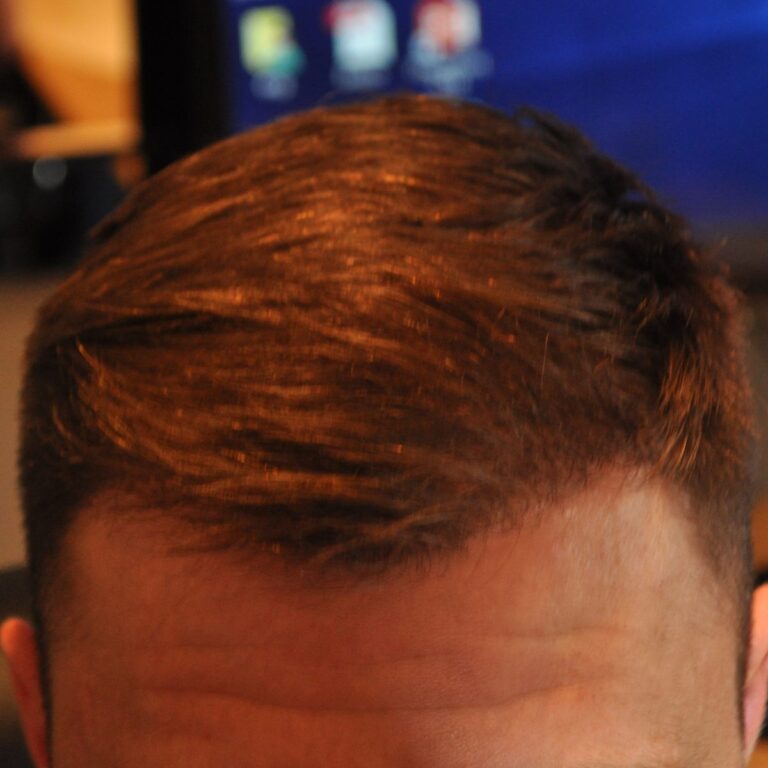 FUE Transplant - Case 1 — after