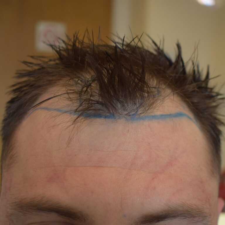FUE Transplant - Case 1 — before