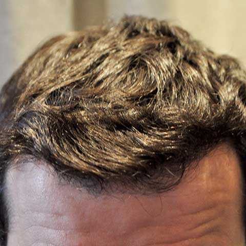 FUE Transplant - Case 10 — after