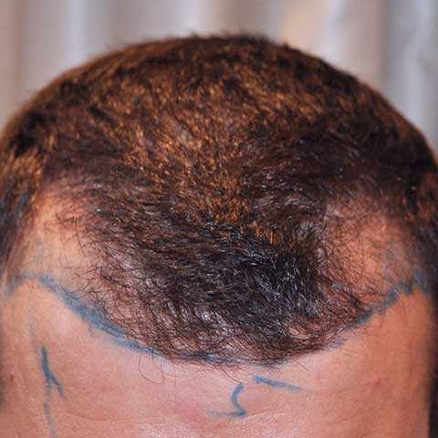 FUE Transplant - Case 10 — before