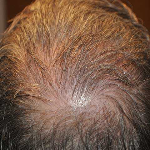 FUT Transplant - Case 11 — after