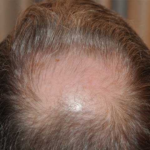 FUT Transplant - Case 11 — before