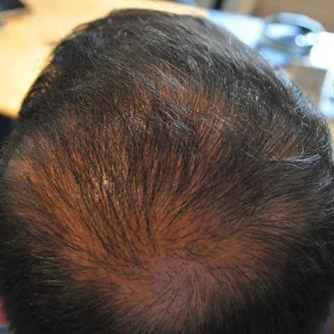FUT Transplant - Case 12 — after