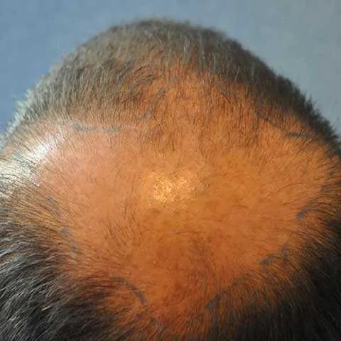 FUT Transplant - Case 12 — before
