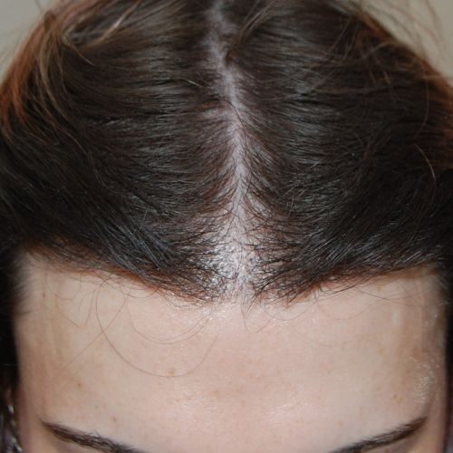 FUT Transplant - Case 14 — after