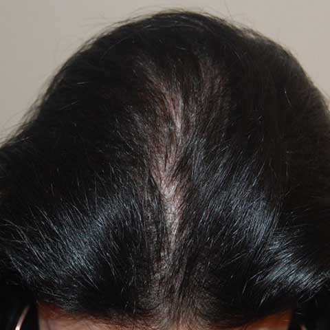 FUT Transplant - Case 15 — after