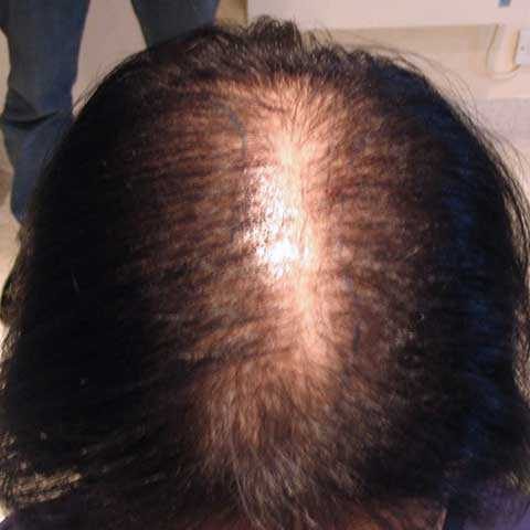 FUT Transplant - Case 15 — before