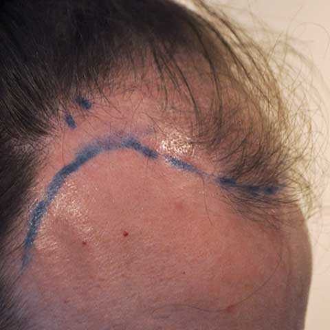 FUT Transplant - Case 16 — before