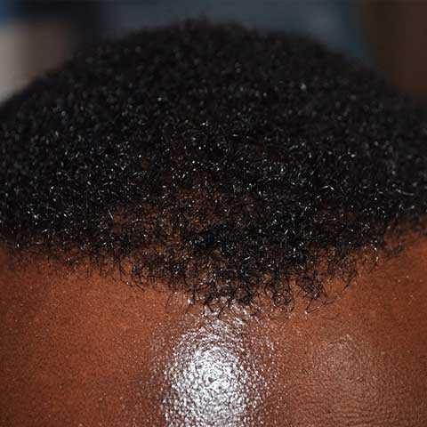 FUE Transplant - Case 17 — after