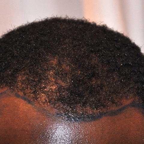 FUE Transplant - Case 17 — before