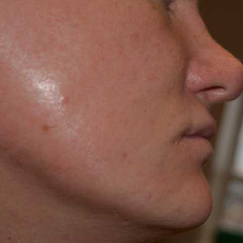 FUE Transplant - Case 19 — before
