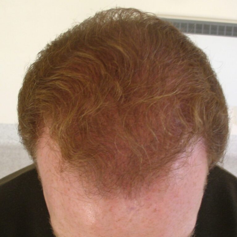 FUT Transplant - Case 2 — after