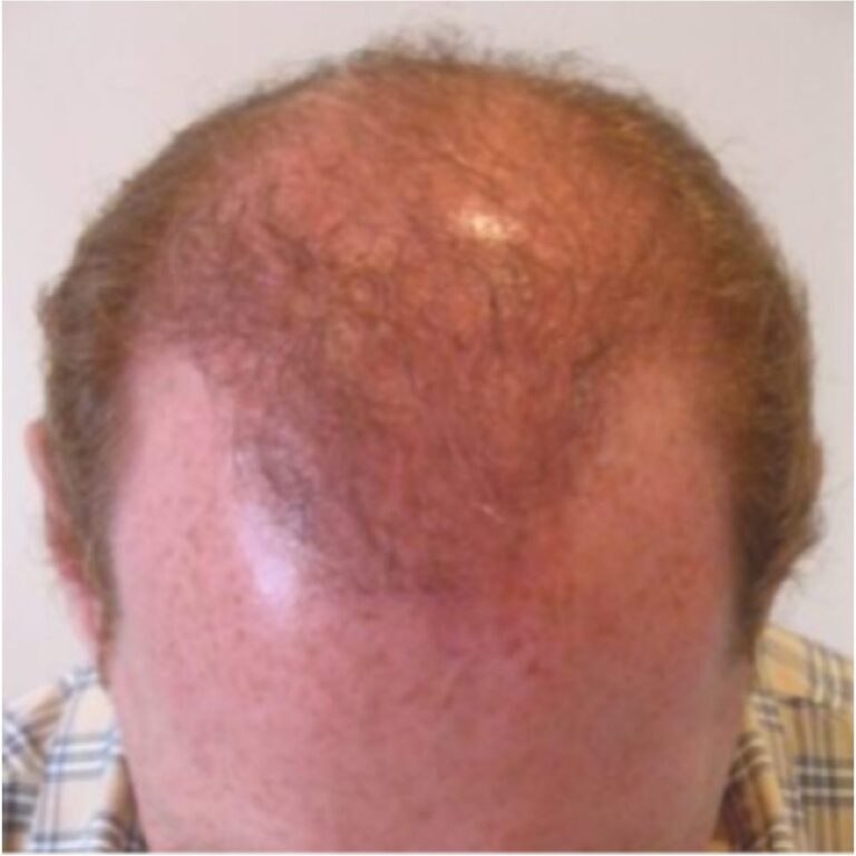 FUT Transplant - Case 2 — before