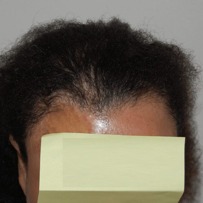 FUE Transplant - Case 20 — after