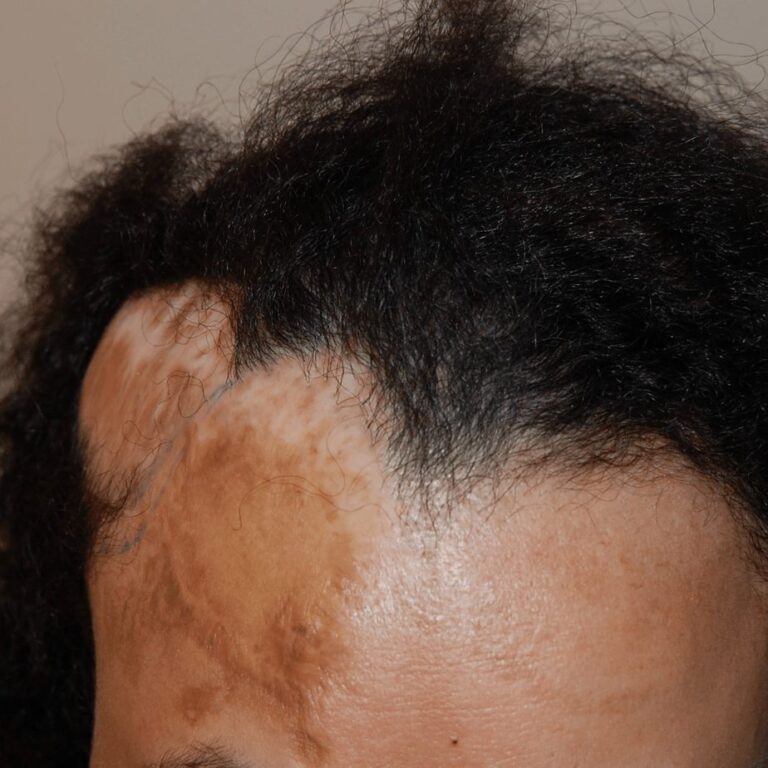 FUE Transplant - Case 20 — before