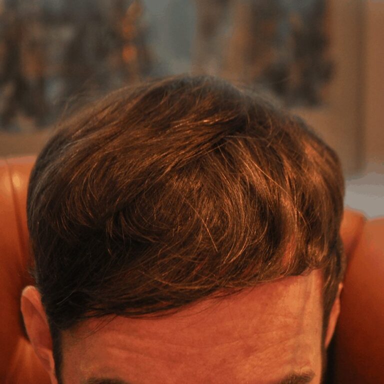 FUE Transplant - Case 21 — after